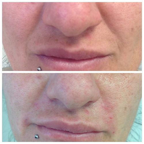 Nose to Mouth Lines Botox Fillers Sheffield £70