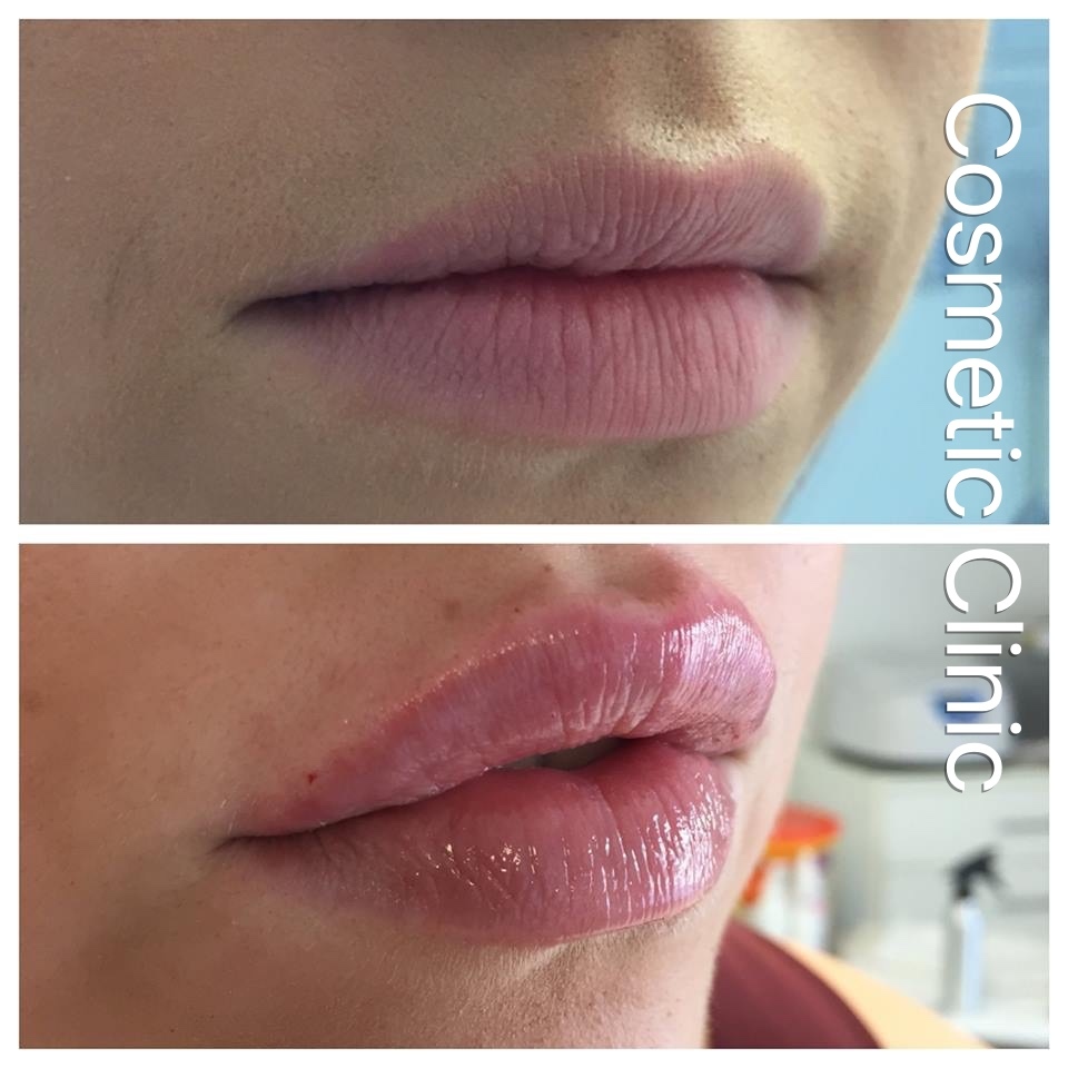 Lips Botox Fillers Sheffield £70