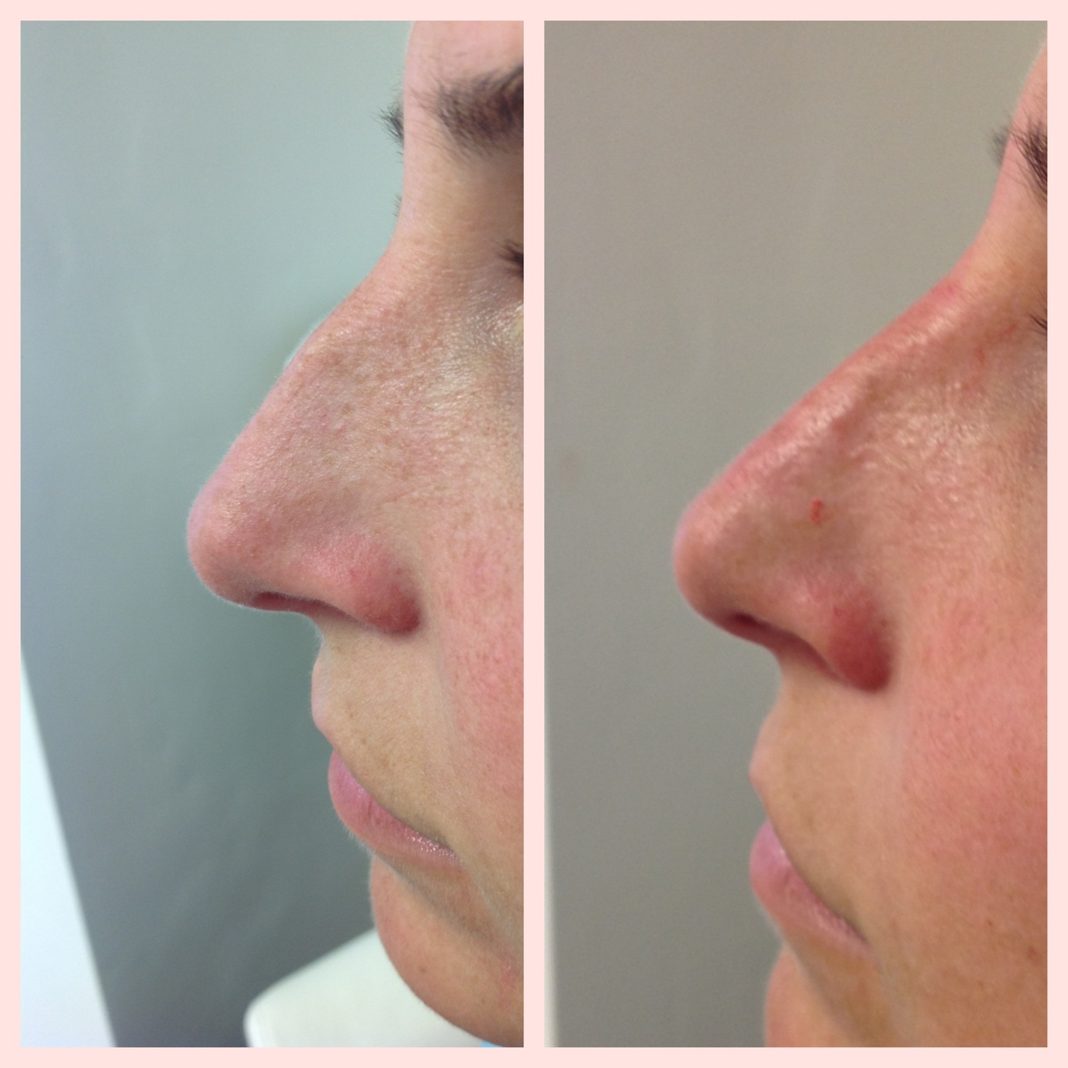 Could Losing Weight Reshape Your Face? The Nose Factor - ew6athe