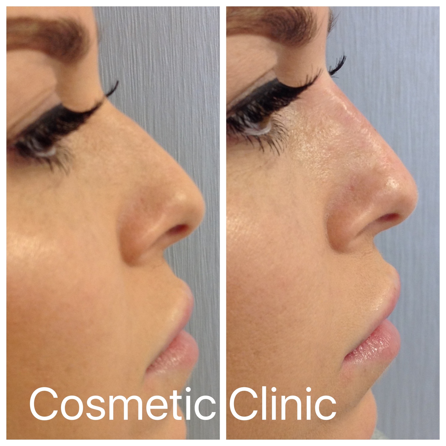 Could Losing Weight Reshape Your Face? The Nose Factor - w3ypwbx
