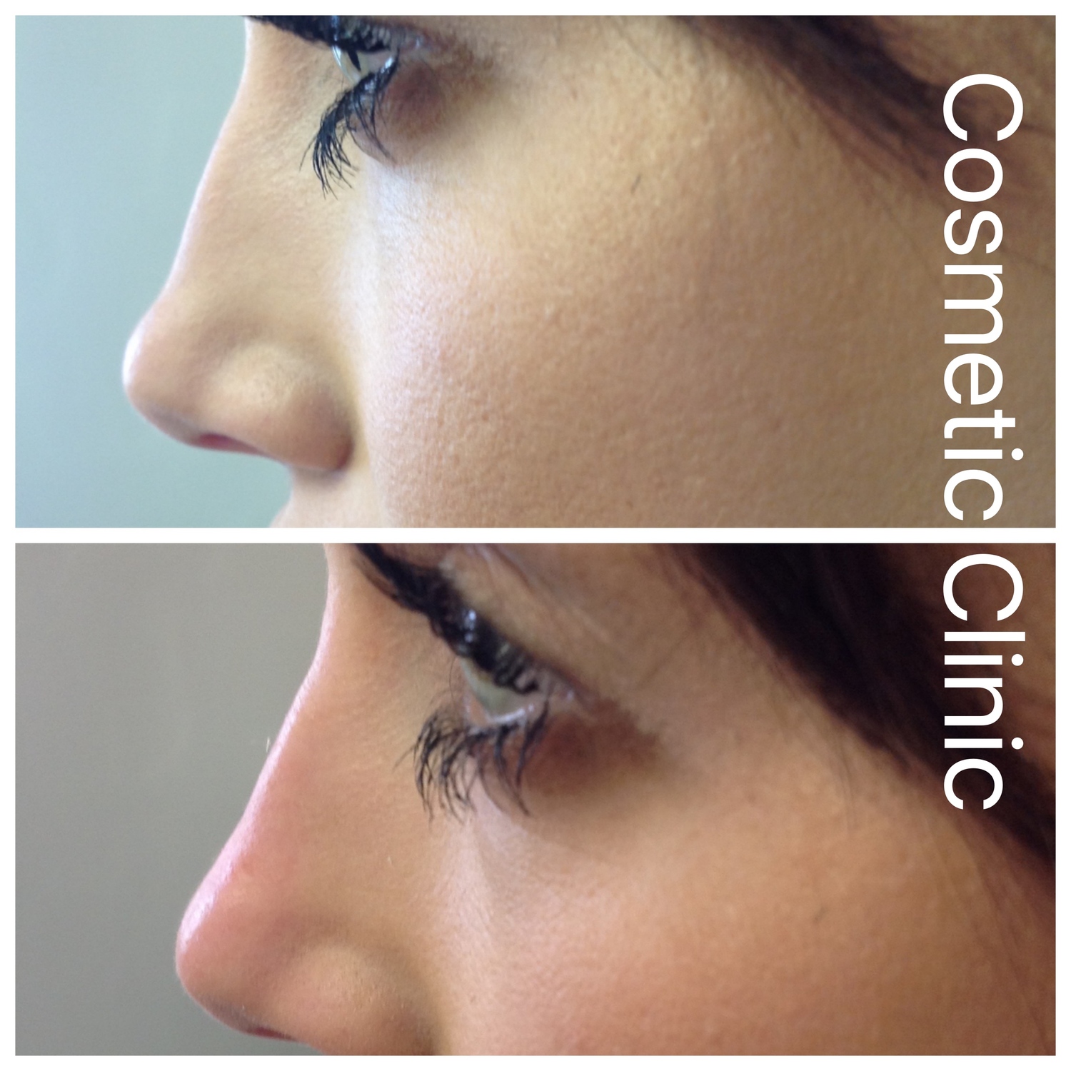 Could Losing Weight Reshape Your Face? The Nose Factor - am79u6r