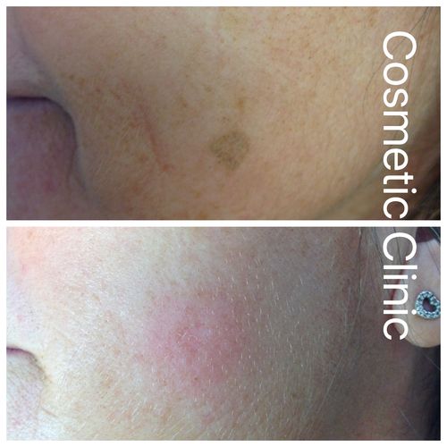 Mole and Lesion Removal Botox Fillers Sheffield £70