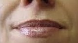 Botox Birmingham, Lip fillers Birmingham, Anti-wrinkle treatment Birmingham
