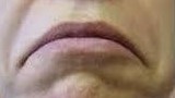 Botox Birmingham, Lip fillers Birmingham, Anti-wrinkle treatment Birmingham