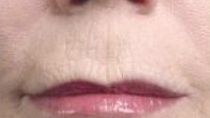 Botox Birmingham, Lip fillers Birmingham, Anti-wrinkle treatment Birmingham