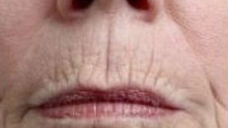Botox Birmingham, Lip fillers Birmingham, Anti-wrinkle treatment Birmingham