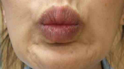 Botox Birmingham, Lip fillers Birmingham, Anti-wrinkle treatment Birmingham