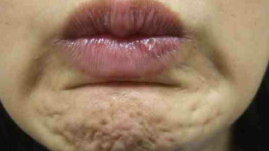Botox Birmingham, Lip fillers Birmingham, Anti-wrinkle treatment Birmingham