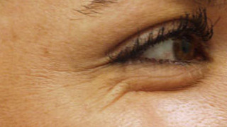 Botox Birmingham, Lip fillers Birmingham, Anti-wrinkle treatment Birmingham