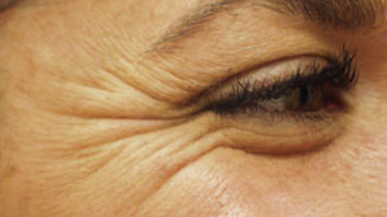 Botox Birmingham, Lip fillers Birmingham, Anti-wrinkle treatment Birmingham