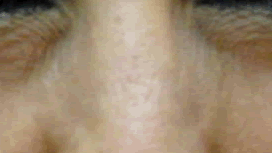 Botox Birmingham, Lip fillers Birmingham, Anti-wrinkle treatment Birmingham