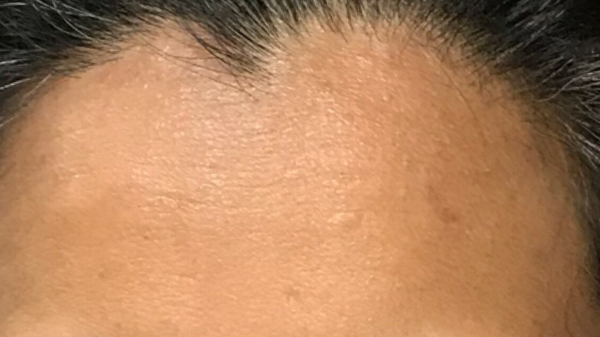 Botox Birmingham, Lip fillers Birmingham, Anti-wrinkle treatment Birmingham