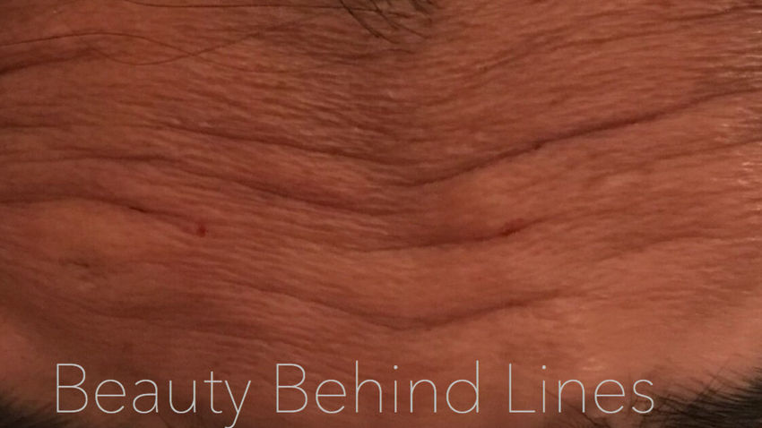 Botox Birmingham, Lip fillers Birmingham, Anti-wrinkle treatment Birmingham