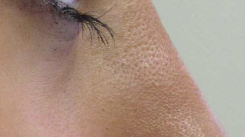 Botox Birmingham, Lip fillers Birmingham, Anti-wrinkle treatment Birmingham
