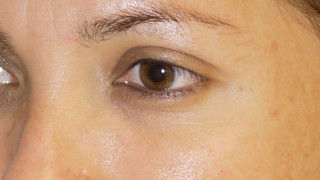 Botox Birmingham, Lip fillers Birmingham, Anti-wrinkle treatment Birmingham