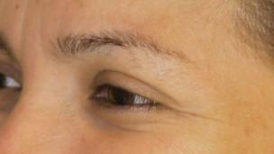 Botox Birmingham, Lip fillers Birmingham, Anti-wrinkle treatment Birmingham