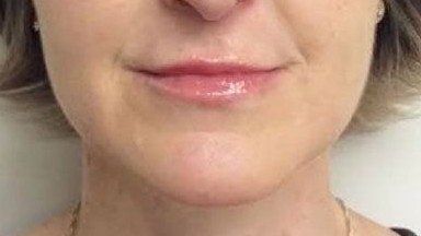 Botox Birmingham, Lip fillers Birmingham, Anti-wrinkle treatment Birmingham