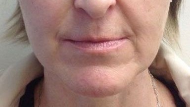 Botox Birmingham, Lip fillers Birmingham, Anti-wrinkle treatment Birmingham