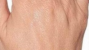 Botox Birmingham, Lip fillers Birmingham, Anti-wrinkle treatment Birmingham