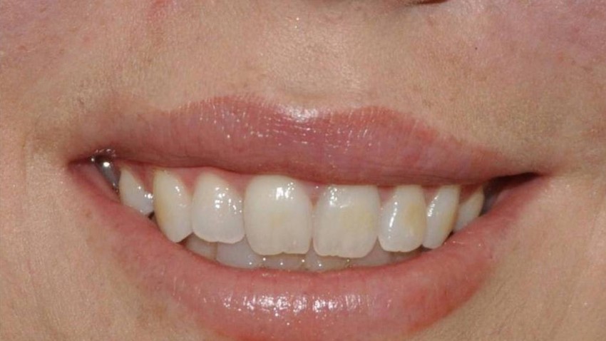 Botox Birmingham, Lip fillers Birmingham, Anti-wrinkle treatment Birmingham