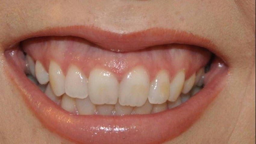 Botox Birmingham, Lip fillers Birmingham, Anti-wrinkle treatment Birmingham