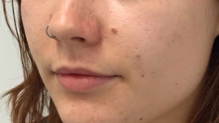 Botox Birmingham, Lip fillers Birmingham, Anti-wrinkle treatment Birmingham