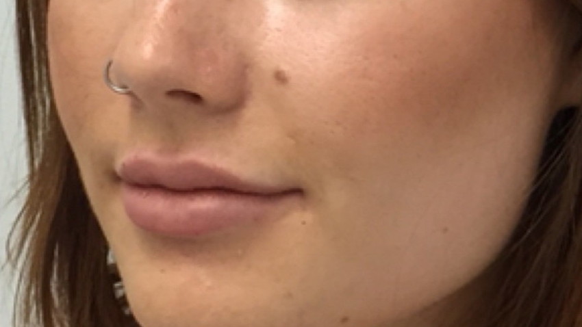 Botox Birmingham, Lip fillers Birmingham, Anti-wrinkle treatment Birmingham
