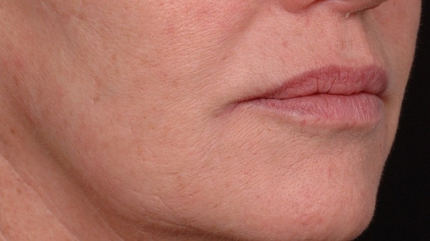 Botox Birmingham, Lip fillers Birmingham, Anti-wrinkle treatment Birmingham