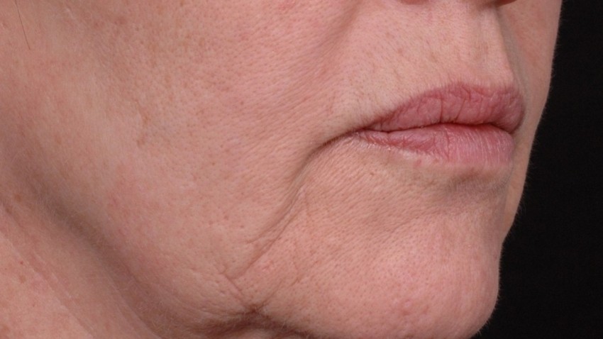 Botox Birmingham, Lip fillers Birmingham, Anti-wrinkle treatment Birmingham
