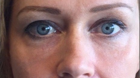 Botox Birmingham, Lip fillers Birmingham, Anti-wrinkle treatment Birmingham