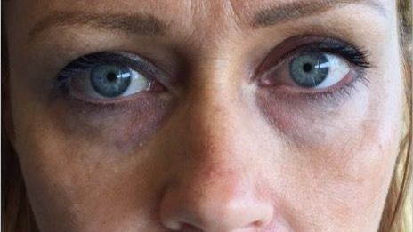 Botox Birmingham, Lip fillers Birmingham, Anti-wrinkle treatment Birmingham