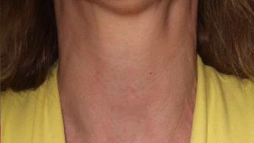 Botox Birmingham, Lip fillers Birmingham, Anti-wrinkle treatment Birmingham