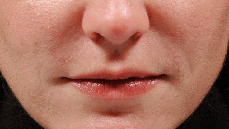 Botox Birmingham, Lip fillers Birmingham, Anti-wrinkle treatment Birmingham