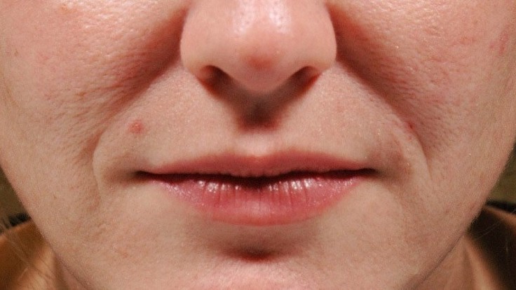 Botox Birmingham, Lip fillers Birmingham, Anti-wrinkle treatment Birmingham