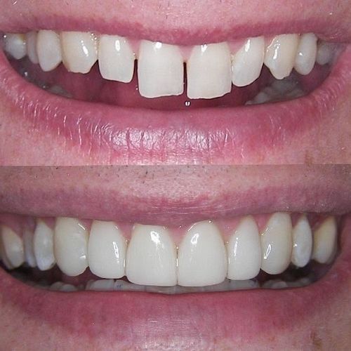 FREE DENTAL BONDING CONSULTATION