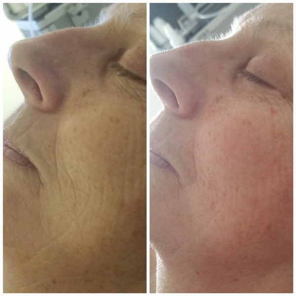 A new you - with our non surgical face lift!