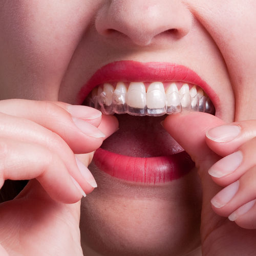 Orthodontic Services Arnold Dental Care Invisalign Dentists NHS