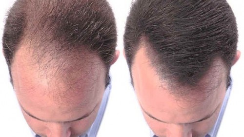 HAIR LOSS AND VITAMIN B7