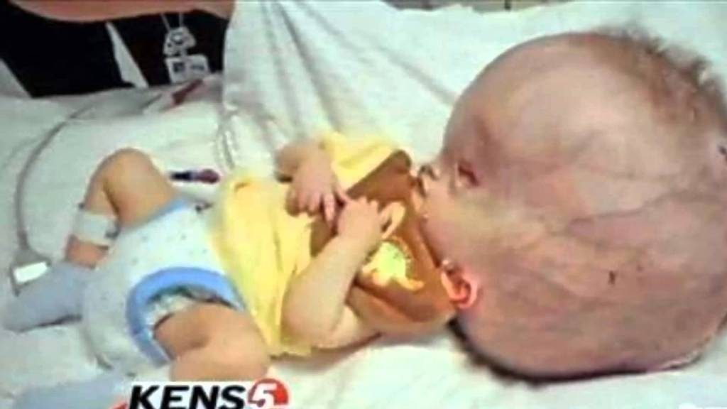 BEBE CON CABEZA GIGANTE. La hidrocefalia