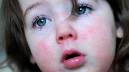 Skarlagensfeber barn