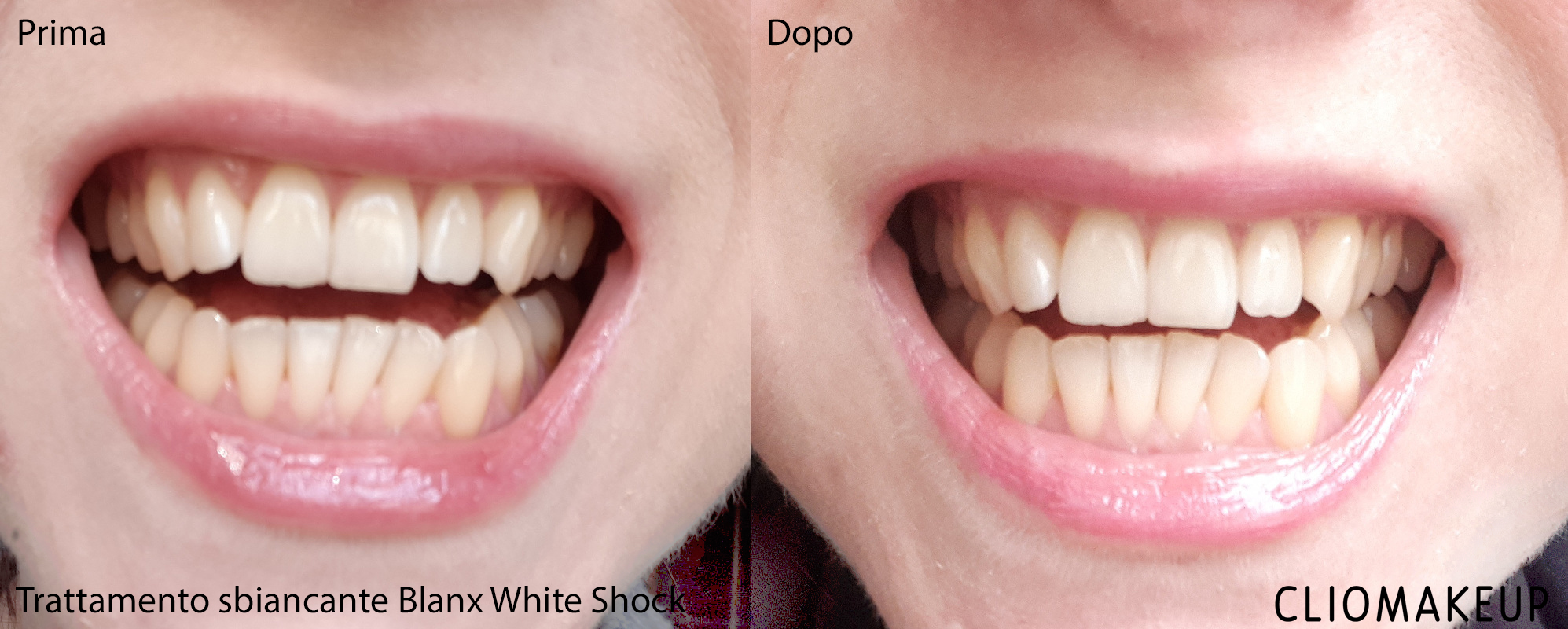 Sbiancamento denti immediato il Team testa