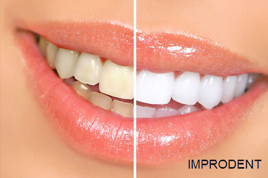 Blanqueamiento dental LED en Clínica Improdent