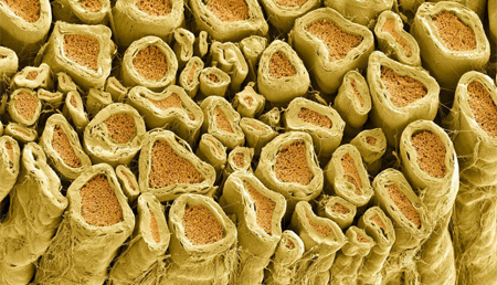 Descrito un mecanismo implicado en la enfermedad de Charcot-Marie-Tooth