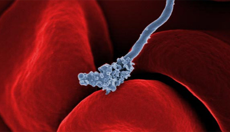 Nuevas infecciones microbianas en cerebros de personas fallecidas por enfermedad de Alzheimer