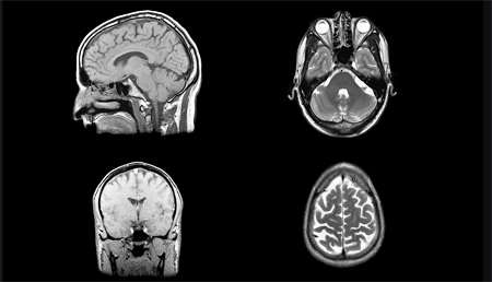 Encuentran un interruptor químico que puede disminuir los síntomas de la esquizofrenia