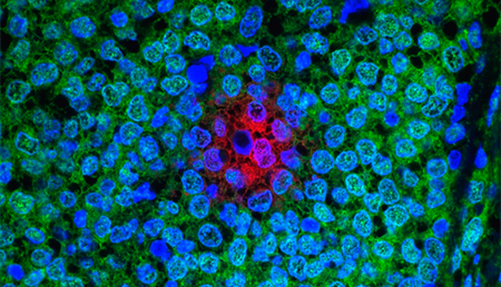 La obesidad y la menopausia podrían modificar el perfil epigenómico del cáncer de mama