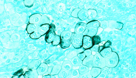 Un panel de biomarcadores para la detección precoz del cáncer de pancreas