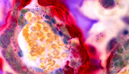 Investigadores españoles describen dos biomarcadores que identifican el riesgo de osteoporosis