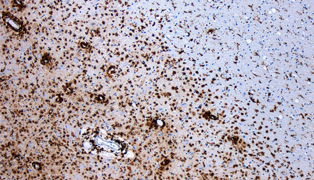 Estudio conduce a un avance en la comprensión de la leucemia mieloide aguda