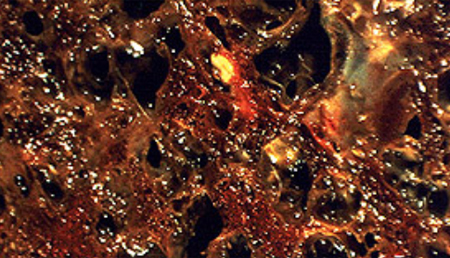 Identifican un gen que podría estar asociado a la fibrosis pulmonar idiopática